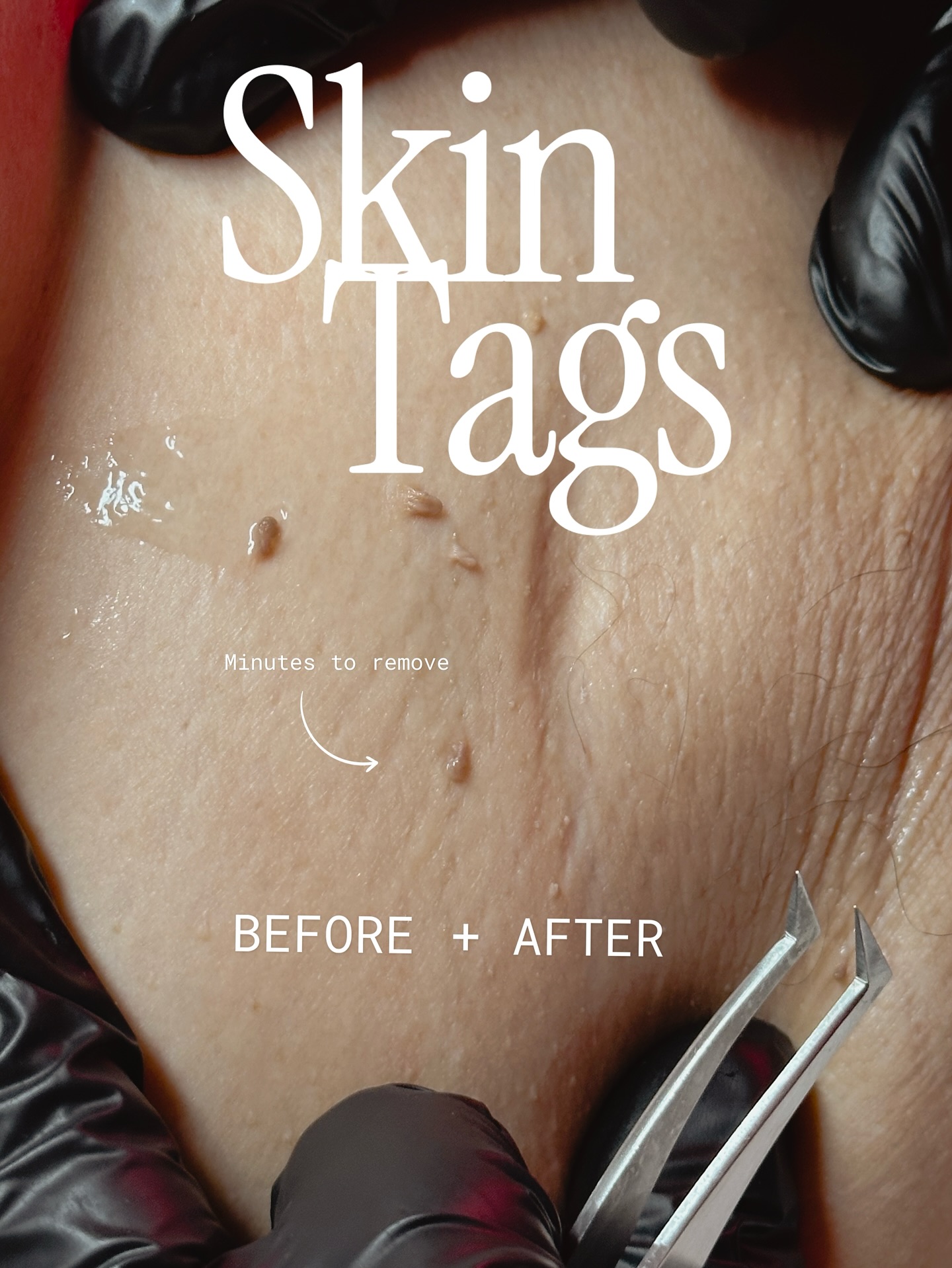 ✨ Say goodbye to skin tags in minutes
Skin tags are completely harmless, but they can sometimes snag on clothing, jewelry, or simply be something you’d rather not see in the mirror every day. Removing them is quick (just 1–5 minutes each depending on size!) and can instantly leave your skin feeling smoother, lighter, and more comfortable.
If you have multiple tags, numbing is available upon request before your appointment so the process is as comfortable as possible.
It’s a simple treatment with a big impact🥰 most clients leave feeling relieved and more confident in their skin. 💖
📅 Book your skin tag removal today and enjoy that “why didn’t I do this sooner?” feeling.
✨ Bonus: In addition to skin tags, I can also safely treat cherry angiomas, pigmentation spots, broken capillaries, and sebaceous hyperplasia👉🏽helping your skin look even clearer and more radiant.
#skintags #skintag #skintagremoval #skintagtreatment #pasadena #facials #facialpasadenaca #pasadenaca #pigmentation #hyperpigmentation