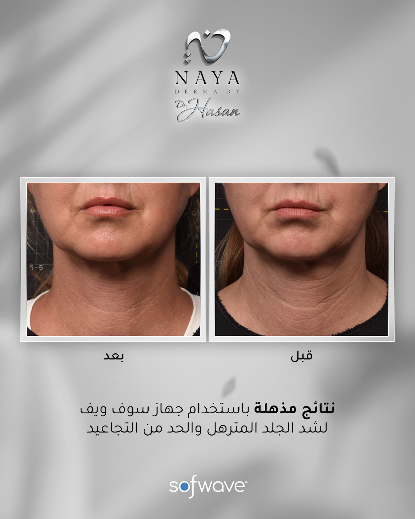 تخلصي من ترهلات الوجه، الرقبة والخطوط الدقيقة بجلسة واحدة وبدون وقت للتعافي.
جهاز Sofwave المعتمد عالمياً وحصريا في نايا ديرما
يمنحكِ النتيجة الفاخرة التي تبحثين عنها دون جراحة أو إبر.
للحجز و الاستفسار
0096871114466
0096824128668
#muscat #naya_derma_by_dr_hasan #sofwave #beforeandafter