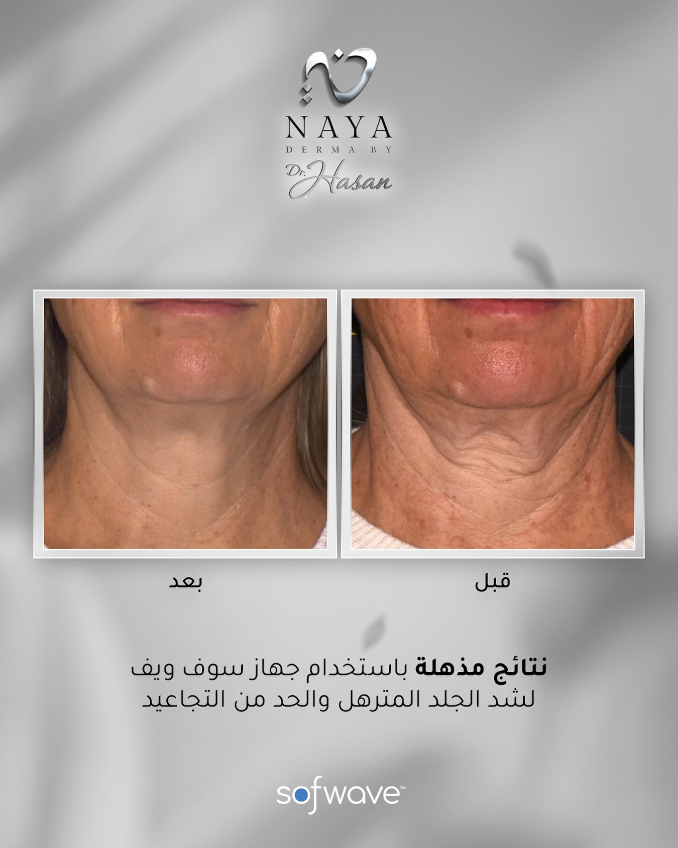  تخلصي من ترهلات الوجه، الرقبة والخطوط الدقيقة بجلسة واحدة وبدون وقت للتعافي.
جهاز Sofwave المعتمد عالمياً وحصريا في نايا ديرما
يمنحكِ النتيجة الفاخرة التي تبحثين عنها دون جراحة أو إبر.
للحجز و الاستفسار
0096871114466
0096824128668
#muscat #naya_derma_by_dr_hasan #sofwave #beforeandafter