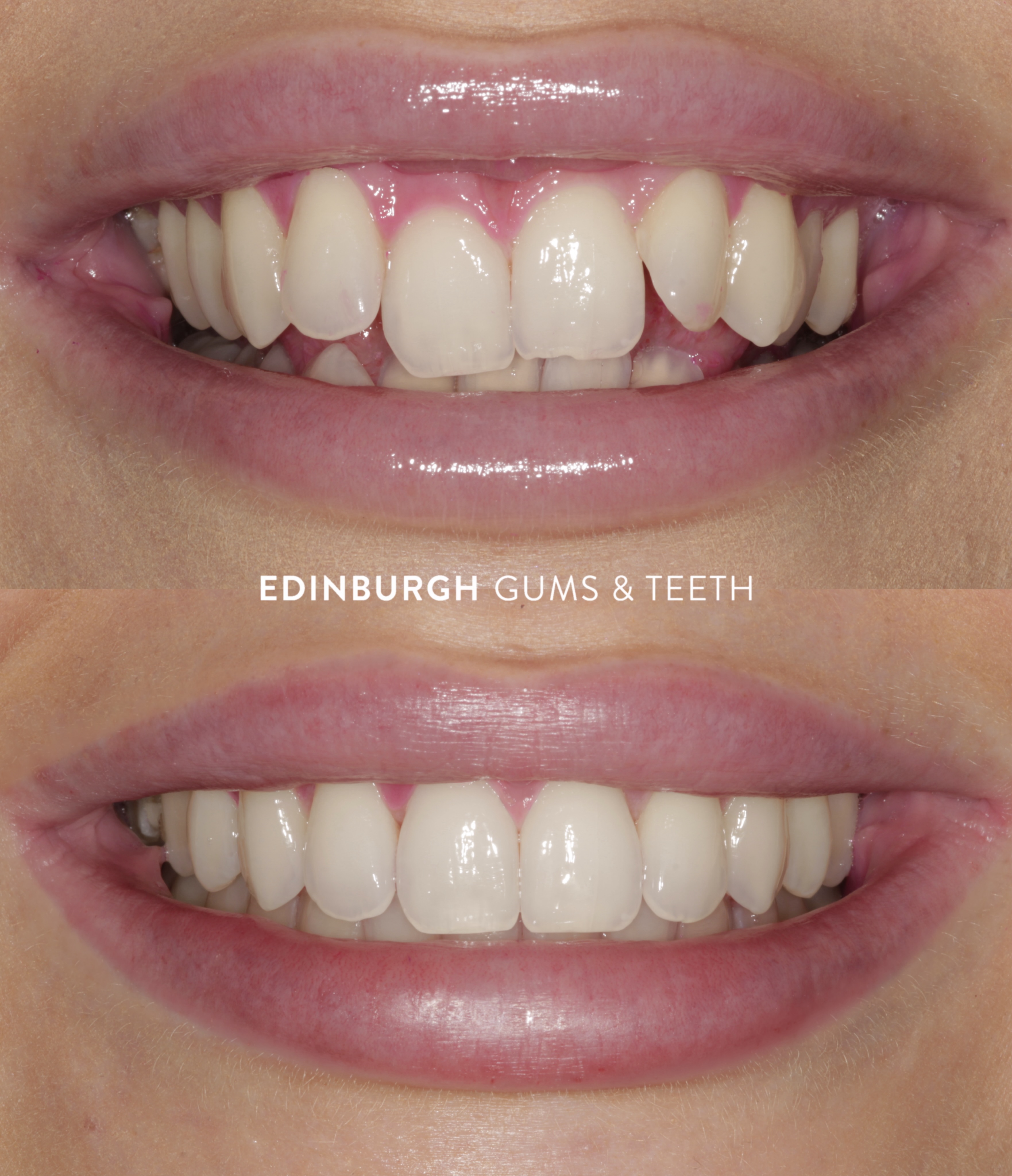 A smile transformation that speaks for itself. ✨
Before and after Invisalign treatment, with results that are natural, healthy and designed to last.
Thinking about straightening your teeth? Book your free Invisalign consultation and see your future smile with a 3D scan.
📍 Edinburgh Gums & Teeth
#Invisalign #SmileTransformation #BeforeAndAfter #StraightTeeth #EdinburghDentist EdinburghGumsAndTeeth edinburghgumsandteeth